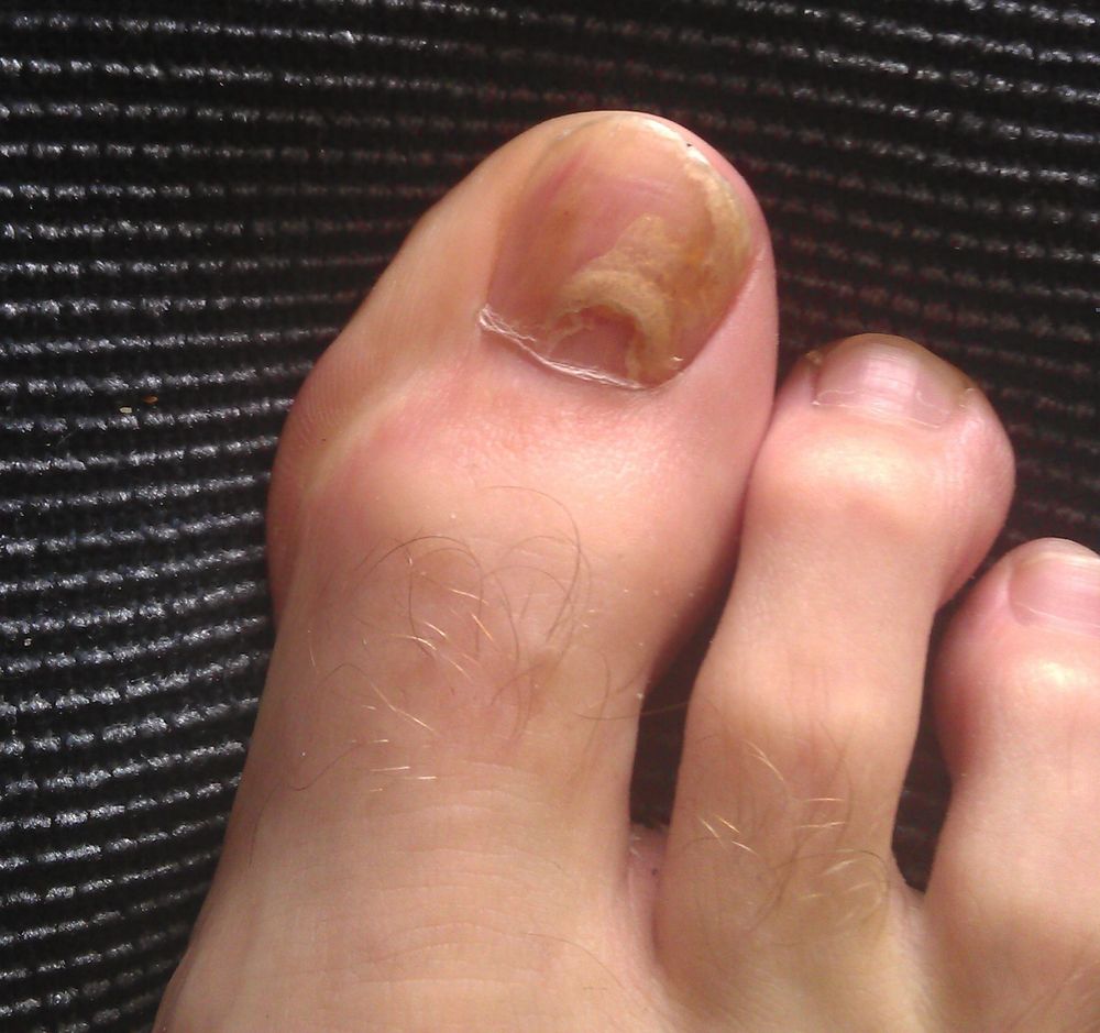 Fungal Toenail Infection: 3 Things You Need To Know